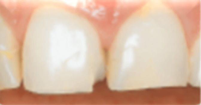 Veneers