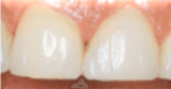 Veneers